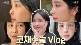 들창코 코재수술 2탄!! 🔥한달차 보형물 부작용으로 튀어나온... 다 정리했습니다 - kakaoTV 들창코 코재수술 2탄!! 🔥한달차 보형물... 