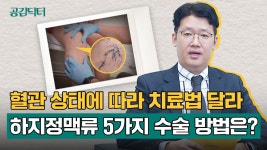 | 공감닥터 - kakaoTV 하지정맥류, 환자 혈관 상태에 따라 결정해야… 통증 적고 회복 빠른 수술법은? | 공감닥터