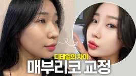 남상 같은 강해보이는 얼굴이 매부리코 정리로 여성스러워 졌어요... kakaoTV 남상 같은 강해보이는 얼굴이 매부리코 정리로 여성스러워... 