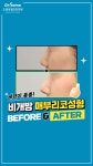 비개방 매부리코수술 비포&애프터🙌 - 강남역 오썸성형외과 - kakaoTV 비개방 매부리코수술 비포&애프터🙌 - 강남역 오썸성형외과