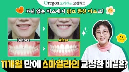 자신 없는 미소에서 밝고 환한 미소로! 스마일라인교정 11개월만에 완료했어요😁 - kakaoTV 자신 없는 미소에서 밝고 환한 미소로!... 