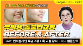 돌출입 교정기간, 교정장치는 알아보기🙌🏻 ─ 오리건치과교정과 - kakaoTV 유학생인데 돌출입교정 했어요!  돌출입 교정기간, 교정장치는... 