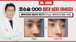 코 성형 수술 시 절대 ㅇㅇㅇ 넣지 마세요! ❌ - kakaoTV 코 성형 수술 시 절대 ㅇㅇㅇ 넣지 마세요! ❌