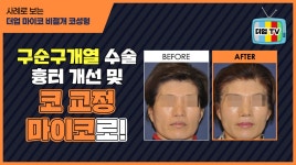 구순구개열(언청이) 수술 후 코교정 및 흉터 개선, 마이코! [교대역 더업(THEUP)성형외과] - kakaoTV 구순구개열(언청이) 수술 후 코교정 및...