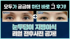 | 모차르트 인기시술✨ | 모차르트성형외과 - kakaoTV 눈두덩이지방이식 전후사진 대량공개! | 모차르트 인기시술✨ | 모차르트성형외과