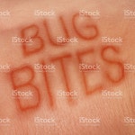 버그 간식 스톡 사진 519420274 | iStock Bug bites medical concept and health care symbol for insect bite...