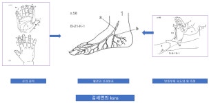 걷기의 재해석 : 스본스도의 질환파악