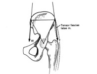 대퇴근막장근(Tensor fascia lata)