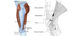 대퇴근막장근(Tensor fascia lata)