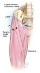 대퇴근막장근(Tensor fascia lata)