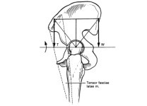 대퇴근막장근(Tensor fascia lata)