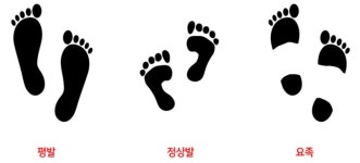 44년 만에 밝혀진 내 발의 비밀