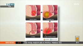 치루 - kakaoTV 치루