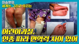 [세계는 그리고 우리는] 어린이괴질, 인종 따라 면역력 차이 있어 - 은병욱 (교수 | 노원 을지대학병원 소아청소년과) - kakaoTV [세계는 그리고... 
