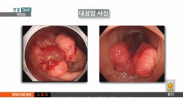 대장암 - kakaoTV 대장암