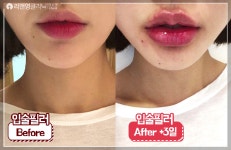 리앤영클리닉 입술필러 전후영상 - kakaoTV 리앤영클리닉 입술필러 전후영상