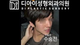 디아이 남자코성형 1개월간의 변화과정 수술후 훈남변신! 더 많은 동영상을 보시려면 ↓↓↓ [디아이TV 보러가 - kakaoTV 디아이... 