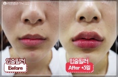리앤영클리닉 입술필러 전후영상 - kakaoTV 리앤영클리닉 입술필러 전후영상