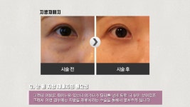 [엔비유의원] 눈밑지방재배치는 왜 필요할까요? - kakaoTV [엔비유의원] 눈밑지방재배치는 왜 필요할까요?