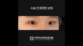 #디아이성형외과, 눈성형후 기간별 얼굴의 변화...궁금하니?! . 직접 보여줄게!!! 디아이성형외과 눈수술 - kakaoTV #디아이성형외과, 눈성형후... 