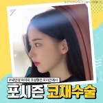 부산 포시즌성형외과 코재수술 - kakaoTV 부산 포시즌성형외과 코재수술
