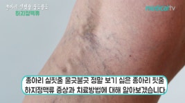종아리 실핏줄 울긋불긋, 하지정맥류 - kakaoTV 종아리 실핏줄 울긋불긋, 하지정맥류