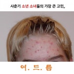 우유가 여드름을 일으키나? 막아주나? - 데일리 푸드앤메드 우유가 여드름을 일으키나? 막아주나?
