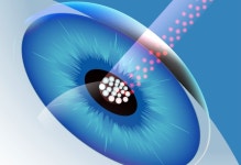 美 대학병원도 적용하는 ‘스마트빔 백내장 수술’ A to Z  - 힐팁 美 대학병원도 적용하는 ‘스마트빔 백내장 수술’ A to Z 