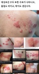 일양약품우 원숭이두창 대상포진 공통증상 수포.두통.근육통.발열 시총100억 유통금액30억 | 일양약품(007570) | 종목토론 - 팍스넷 증권포털