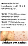 일양약품우 원숭이두창 대상포진 공통증상 수포.두통.근육통.발열 시총100억 유통금액30억 | 일양약품(007570) | 종목토론 - 팍스넷 증권포털