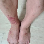 아버지 피부에 붉은 반점이 나는데 무슨 병일까요? ㅣ 궁금할 땐, 아하!