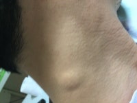 목에 덩어리 혹처럼 잡히는게 있습니다 ㅣ 궁금할 땐, 아하!