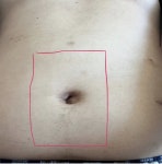 배꼽탈장수술 후 인공막 넣음 위치 따가움? ㅣ 궁금할 땐, 아하!