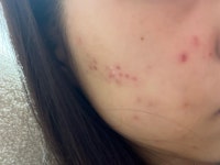 여드름,흉터치료 아크리프크림 효과 x 하얀나라스킨 효과x ㅣ 궁금할 땐, 아하!
