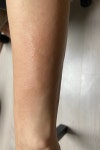 팔에 피부가 가렵고 두꺼워졌어요 ㅣ 궁금할 땐, 아하!