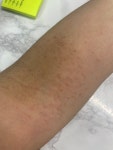 왼쪽 팔 접히는 부분만 자꾸 간지럽고 사진과같아요 어떻게 간지러움을 없앨까요? ㅣ 궁금할 땐, 아하!