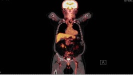 Positron Emission Tomography (pet) of 스톡 동영상 비디오(100% 로열티 프리) 1020322645 | Shutterstock