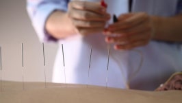 Electro-acupuncture.traditional Chinese Acupuncture and Electro 스톡 동영상 비디오(100% 로열티 프리) 1058855224 | Shutterstock
