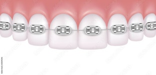 Braces 36657704 Vector Art at Vecteezy Download Braces for free