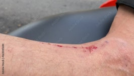 Fresh bloody wound injury on mans leg right after accident with blurred traffic on road in background daytime. Road safety... 