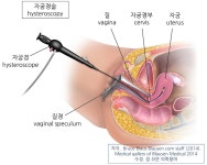 이슈/유머 - 난임시술(시험관, 인공수정) 과정은 이렇게 진행됨