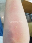 알레르기, 알레르기검사, 검사, allergy, hives, 사진,이미지,일러스트,캘리그라피 - 현아_HYUNA작가 크라우드픽 - 저작권 걱정 없는 상업용... 