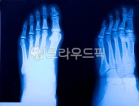 뼈, 정형, 외과, 정형외과, 발가락, 사진,이미지,일러스트,캘리그라피 - Nepoto1작가 크라우드픽 - 저작권 걱정 없는 상업용 이미지
