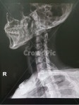 medicalimagingxrayfilm, 의료영상x선필름, xray, 엑스레이, 목엑스레이, 사진,이미지,일러스트,캘리그라피 - Jinejine작가 크라우드픽... 