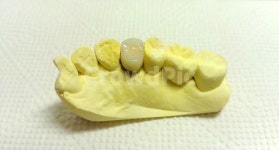 치과, 보철, 치아, 치과기공사, dental, 사진,이미지,일러스트,캘리그라피 - SeeOn작가 크라우드픽 - 저작권 걱정 없는 상업용 이미지