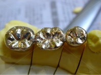 치과, 보철, 의료, 치과기공사, 골드크라운, 사진,이미지,일러스트,캘리그라피 - SeeOn작가 크라우드픽 - 저작권 걱정 없는 상업용 이미지