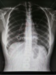 xray, 엑스레이, medicalimagingxrayfilm, chest, 흉부, 사진,이미지,일러스트,캘리그라피 - Jinejine작가 크라우드픽 - 저작권 걱정... 