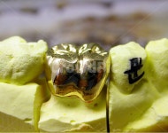 치과, 의료, 골드크라운, 치과기공, 어금니, 사진,이미지,일러스트,캘리그라피 - SeeOn작가 크라우드픽 - 저작권 걱정 없는 상업용 이미지