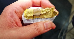 치과, 보철, 덴탈, dental, 치과기공, 사진,이미지,일러스트,캘리그라피 - SeeOn작가 크라우드픽 - 저작권 걱정 없는 상업용 이미지