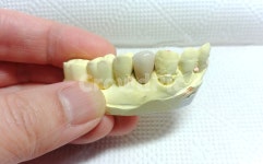 치과, 보철, 치아, 치과기공사, dental, 사진,이미지,일러스트,캘리그라피 - SeeOn작가 크라우드픽 - 저작권 걱정 없는 상업용 이미지